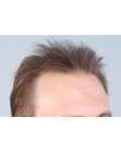 Before Hair Transplant&nbsp;2 Sessions (Areas)